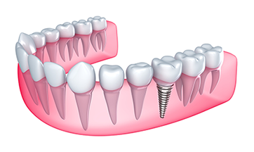 Dental Implants - Dentist In Dearborn, MI | Gusfa Dental Care